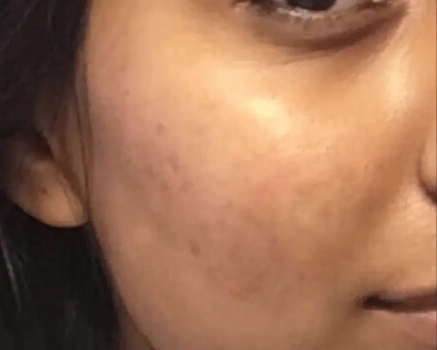 Skin after acne treatment
