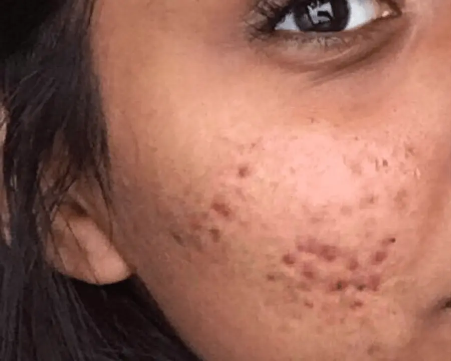 Skin before acne treatment