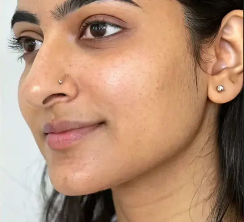 Skin after pigmentation treatment