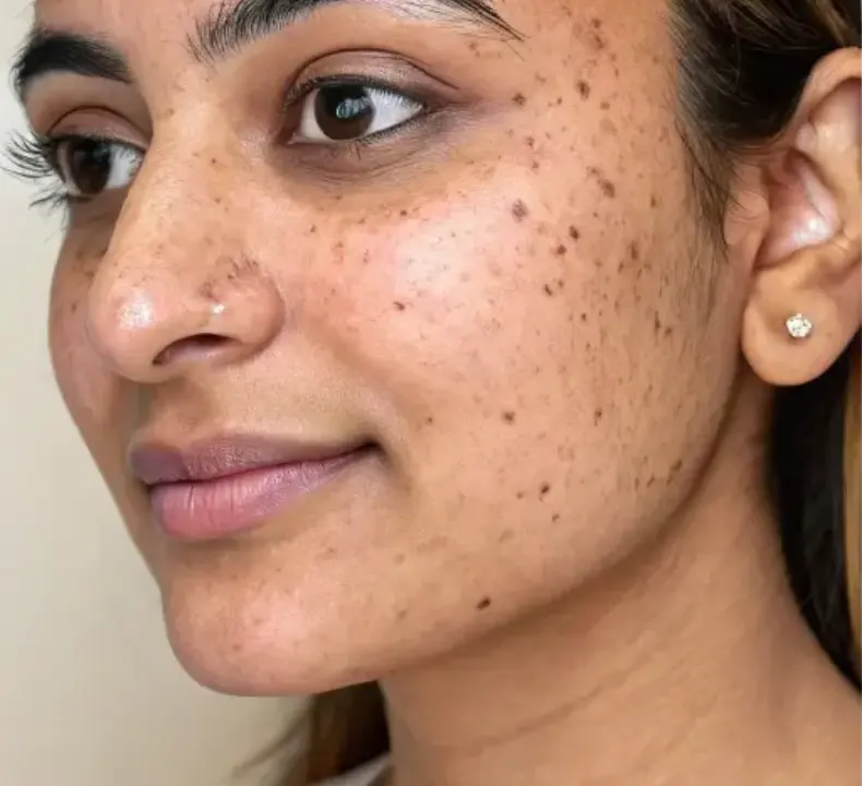 Skin before pigmentation treatment